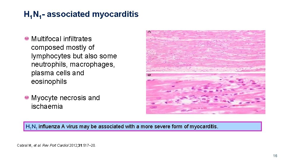 H 1 N 1 - associated myocarditis Multifocal infiltrates composed mostly of lymphocytes but