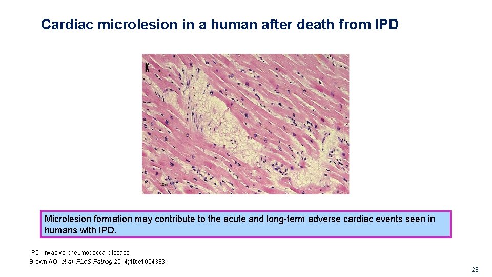 Cardiac microlesion in a human after death from IPD Microlesion formation may contribute to