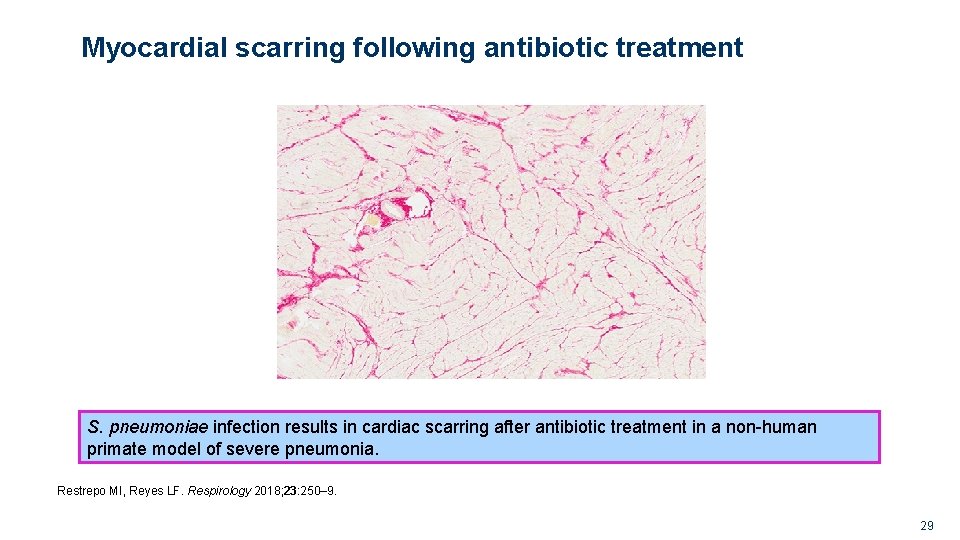 Myocardial scarring following antibiotic treatment S. pneumoniae infection results in cardiac scarring after antibiotic