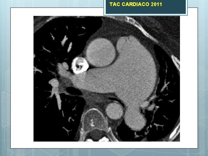 TAC CARDIACO 2011 