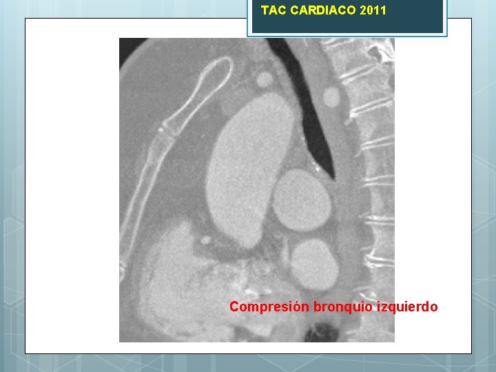 TAC CARDIACO 2011 Compresión bronquio izquierdo 