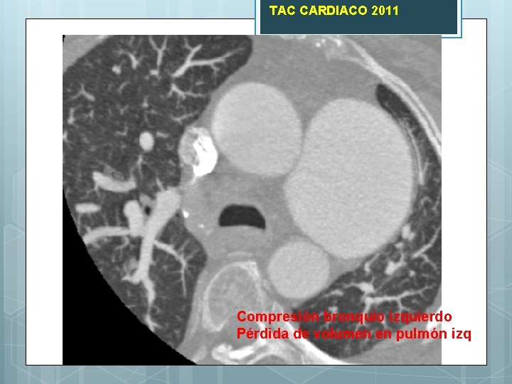 TAC CARDIACO 2011 Compresión bronquio izquierdo Pérdida de volumen en pulmón izq 