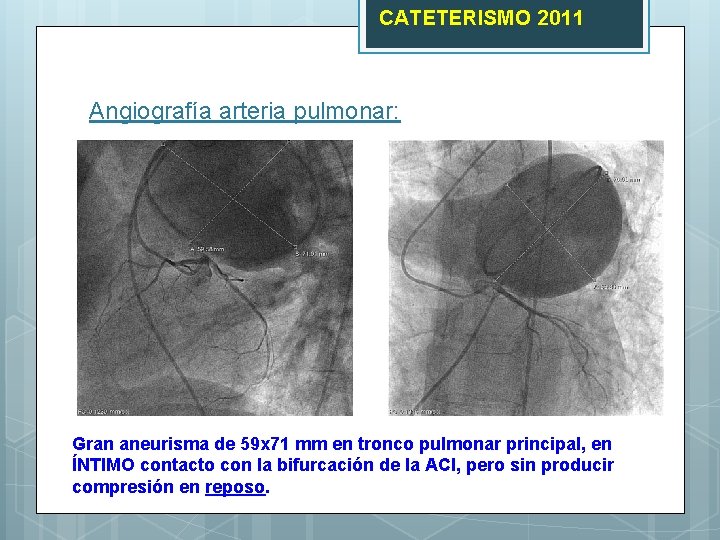 CATETERISMO 2011 Angiografía arteria pulmonar: Gran aneurisma de 59 x 71 mm en tronco