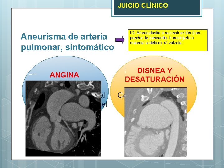 JUICIO CLÍNICO Aneurisma de arteria pulmonar, sintomático ANGINA Posiblemente por compresión de TCI al