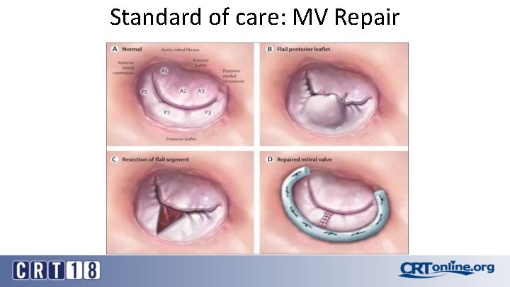Standard of care: MV Repair 