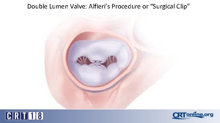 Double Lumen Valve: Alfieri’s Procedure or “Surgical Clip” 