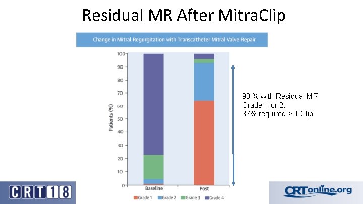 Residual MR After Mitra. Clip 93 % with Residual MR Grade 1 or 2.