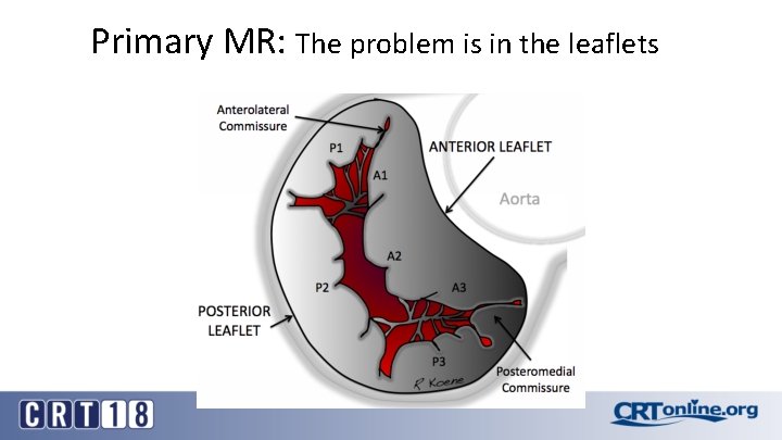 Primary MR: The problem is in the leaflets 