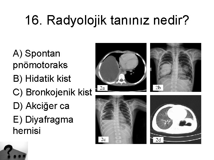 16. Radyolojik tanınız nedir? A) Spontan pnömotoraks B) Hidatik kist C) Bronkojenik kist D)