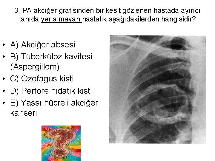 3. PA akciğer grafisinden bir kesit gözlenen hastada ayırıcı tanıda yer almayan hastalık aşağıdakilerden