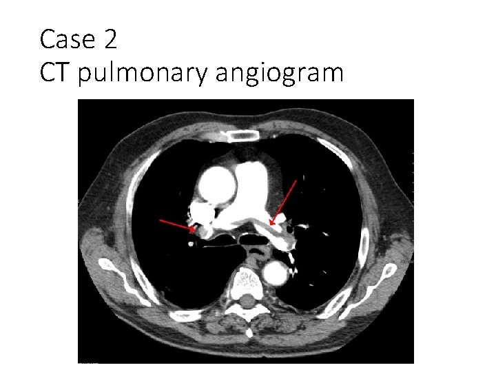 Case 2 CT pulmonary angiogram 