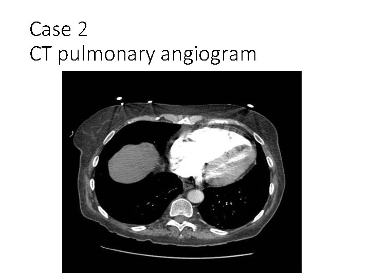 Case 2 CT pulmonary angiogram 