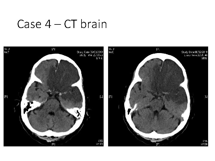 Case 4 – CT brain 