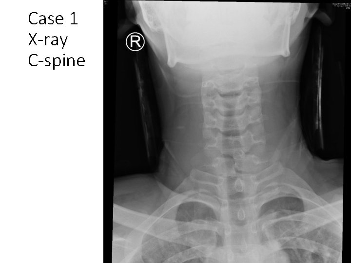 Case 1 X-ray C-spine 