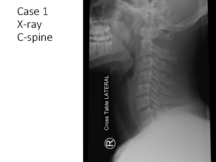 Case 1 X-ray C-spine 