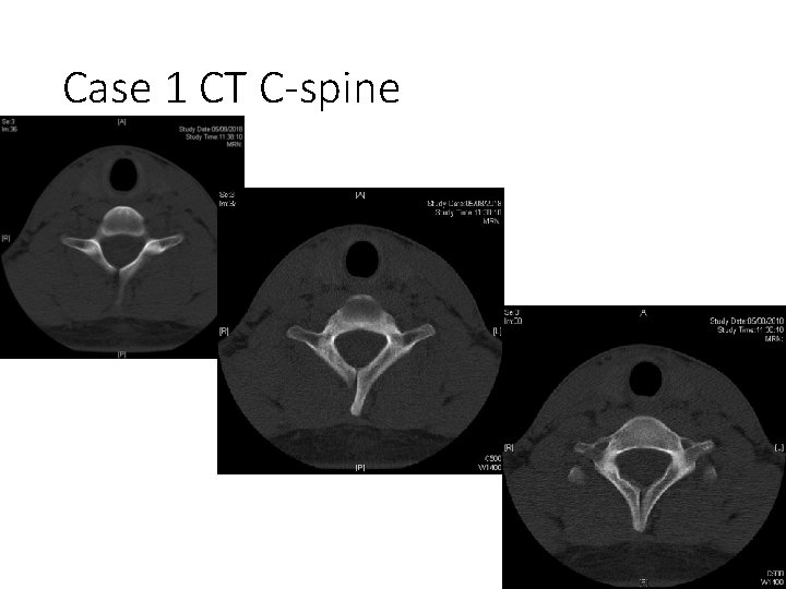 Case 1 CT C-spine 