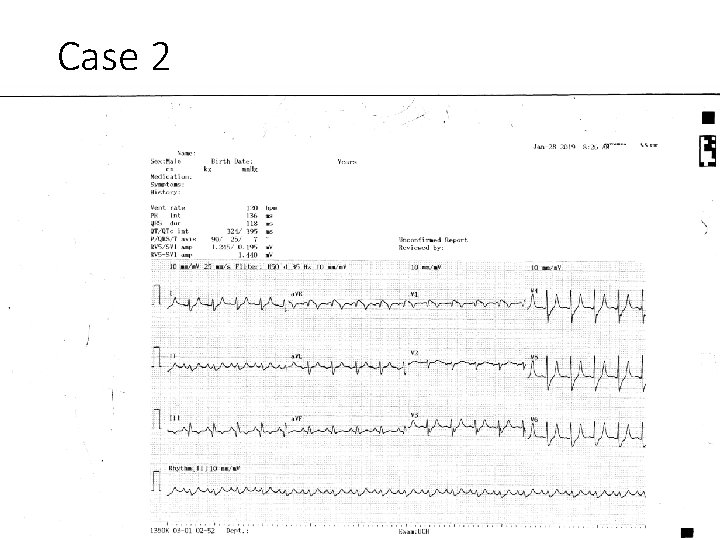 Case 2 ECG 