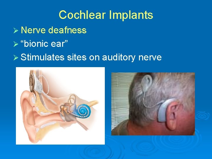 Cochlear Implants Ø Nerve deafness Ø “bionic ear” Ø Stimulates sites on auditory nerve