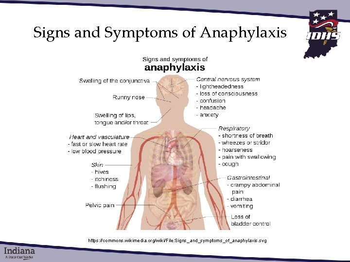 Signs and Symptoms of Anaphylaxis https: //commons. wikimedia. org/wiki/File: Signs_and_symptoms_of_anaphylaxis. svg 