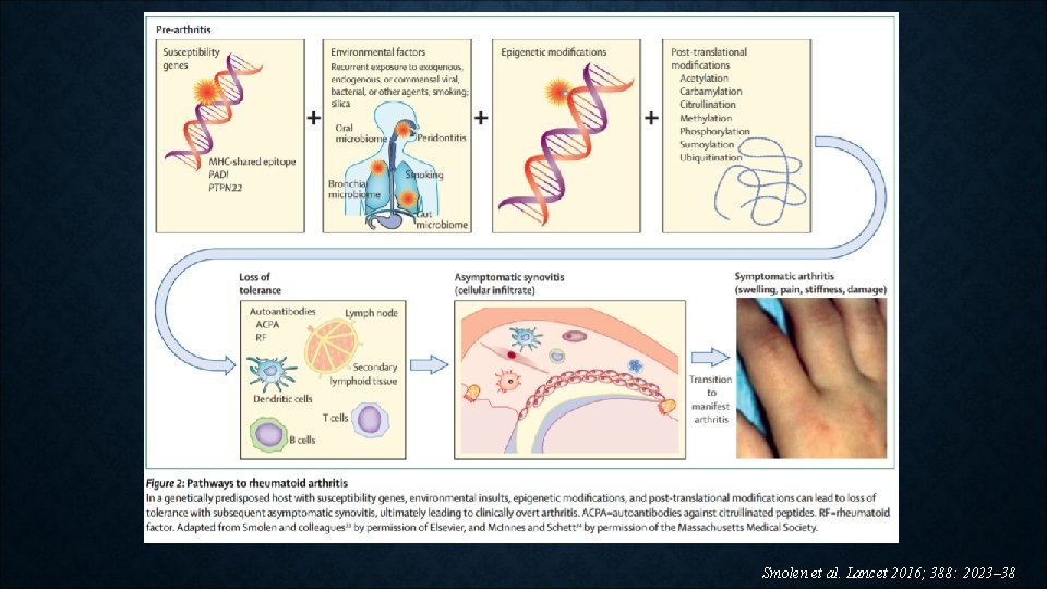 Smolen et al. Lancet 2016; 388: 2023– 38 Smolen et al. Lancet 2016; 388: 2023– 38