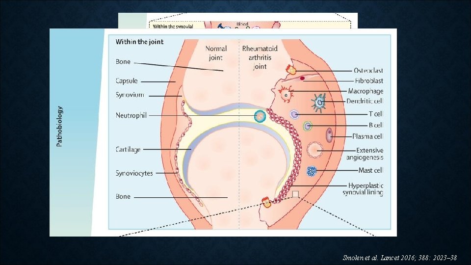 Smolen et al. Lancet 2016; 388: 2023– 38 Smolen et al. Lancet 2016; 388: 2023– 38