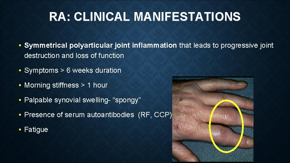 RA: CLINICAL MANIFESTATIONS • Symmetrical polyarticular joint inflammation that leads to progressive joint destruction RA: CLINICAL MANIFESTATIONS • Symmetrical polyarticular joint inflammation that leads to progressive joint destruction