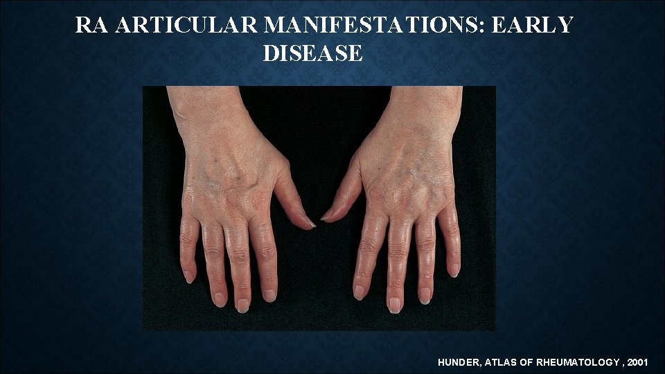 RA ARTICULAR MANIFESTATIONS: EARLY DISEASE HUNDER, ATLAS OF RHEUMATOLOGY , 2001 RA ARTICULAR MANIFESTATIONS: EARLY DISEASE HUNDER, ATLAS OF RHEUMATOLOGY , 2001