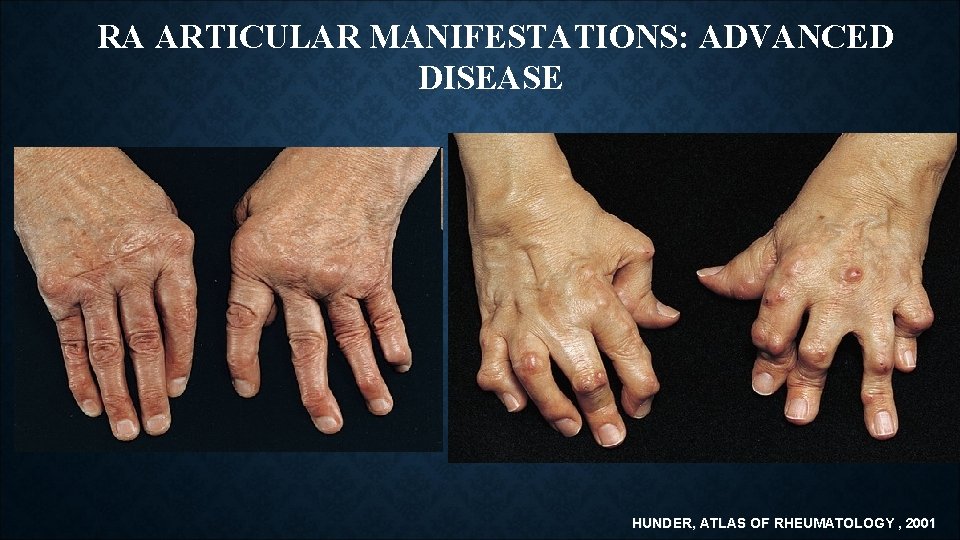 RA ARTICULAR MANIFESTATIONS: ADVANCED DISEASE HUNDER, ATLAS OF RHEUMATOLOGY , 2001 RA ARTICULAR MANIFESTATIONS: ADVANCED DISEASE HUNDER, ATLAS OF RHEUMATOLOGY , 2001
