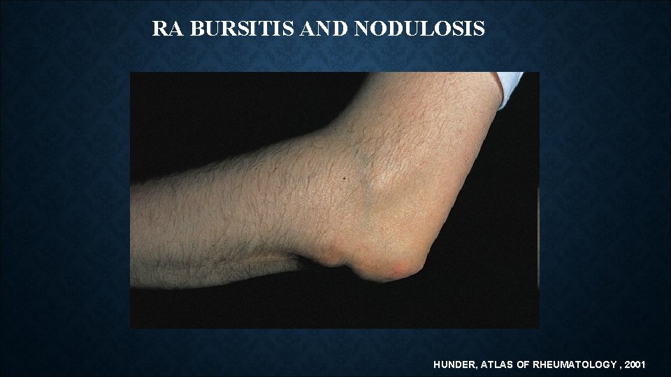 RA BURSITIS AND NODULOSIS HUNDER, ATLAS OF RHEUMATOLOGY , 2001 RA BURSITIS AND NODULOSIS HUNDER, ATLAS OF RHEUMATOLOGY , 2001
