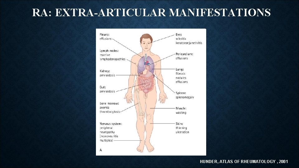 RA: EXTRA-ARTICULAR MANIFESTATIONS HUNDER, ATLAS OF RHEUMATOLOGY , 2001 RA: EXTRA-ARTICULAR MANIFESTATIONS HUNDER, ATLAS OF RHEUMATOLOGY , 2001