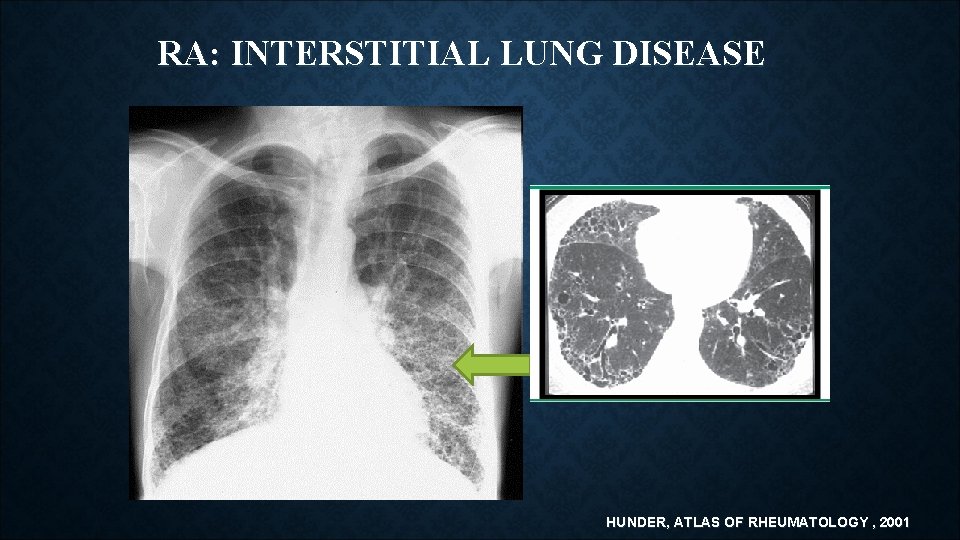 RA: INTERSTITIAL LUNG DISEASE HUNDER, ATLAS OF RHEUMATOLOGY , 2001 RA: INTERSTITIAL LUNG DISEASE HUNDER, ATLAS OF RHEUMATOLOGY , 2001