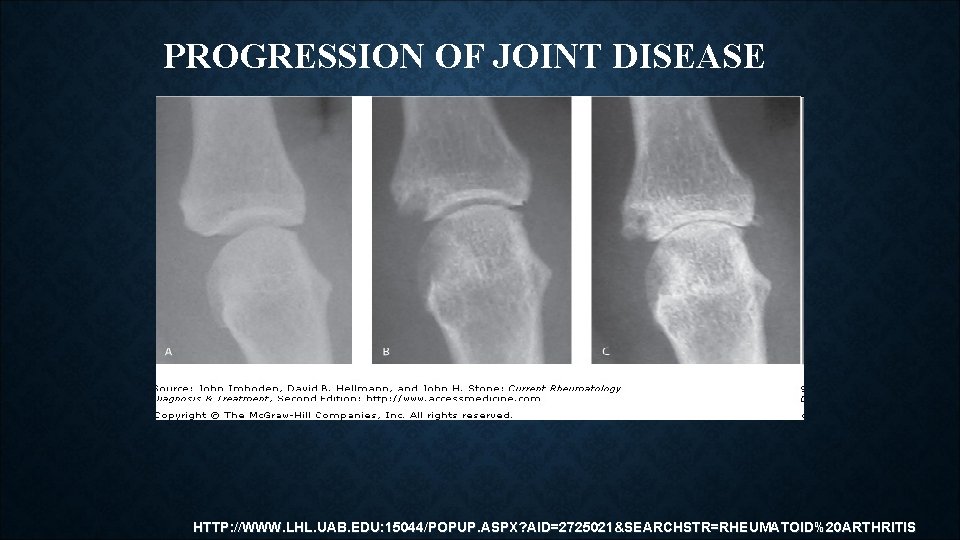 PROGRESSION OF JOINT DISEASE HTTP: //WWW. LHL. UAB. EDU: 15044/POPUP. ASPX? AID=2725021&SEARCHSTR=RHEUMATOID%20 ARTHRITIS PROGRESSION OF JOINT DISEASE HTTP: //WWW. LHL. UAB. EDU: 15044/POPUP. ASPX? AID=2725021&SEARCHSTR=RHEUMATOID%20 ARTHRITIS