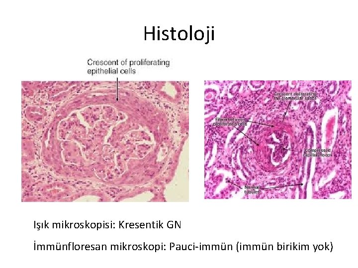 Histoloji Işık mikroskopisi: Kresentik GN İmmünfloresan mikroskopi: Pauci-immün (immün birikim yok) 