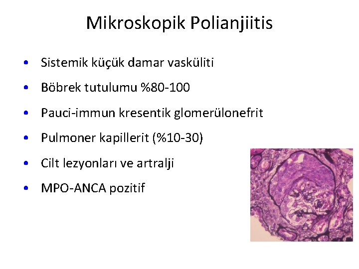Mikroskopik Polianjiitis • Sistemik küçük damar vasküliti • Böbrek tutulumu %80 -100 • Pauci-immun