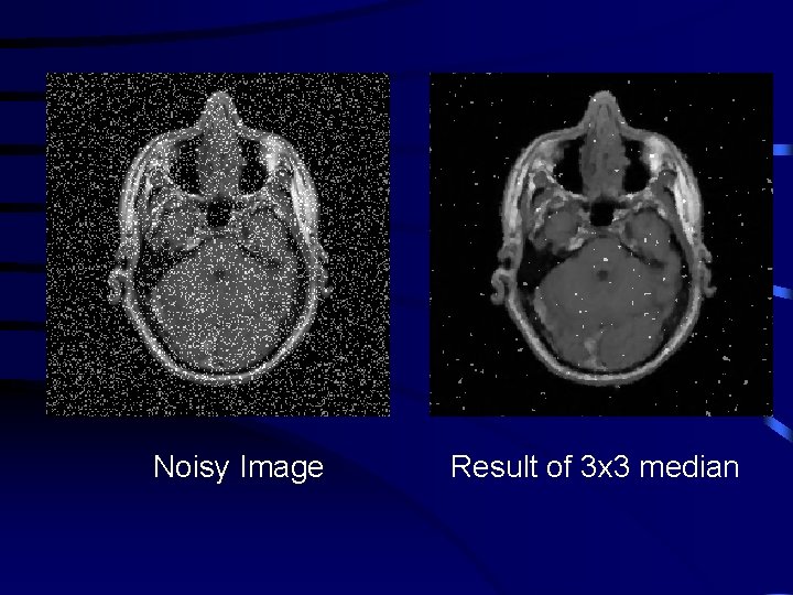 Noisy Image Result of 3 x 3 median 