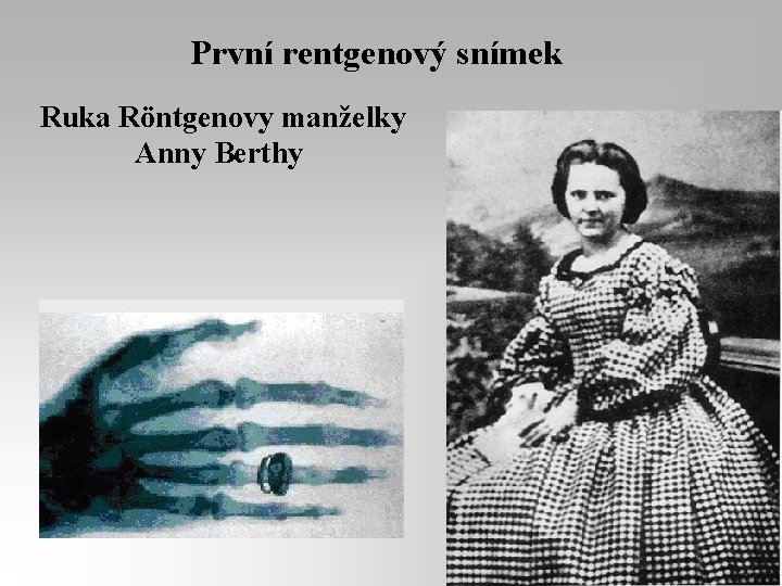První rentgenový snímek Ruka Röntgenovy manželky Anny Berthy 