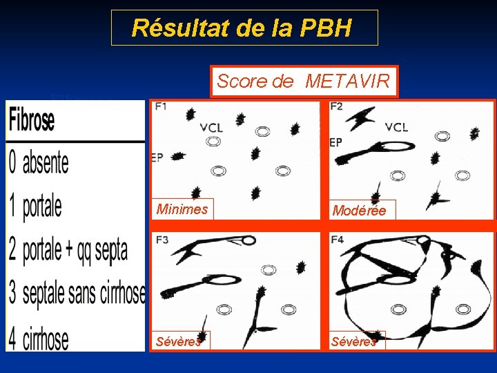 Résultat de la PBH Score de METAVIR Fibrose : Minimes Modérée Sévères 