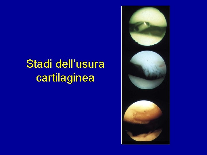 Stadi dell’usura cartilaginea 