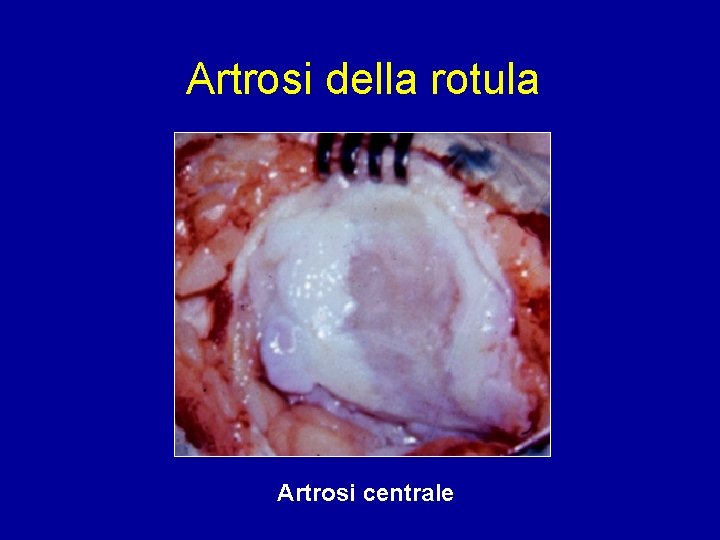Artrosi della rotula Artrosi centrale 