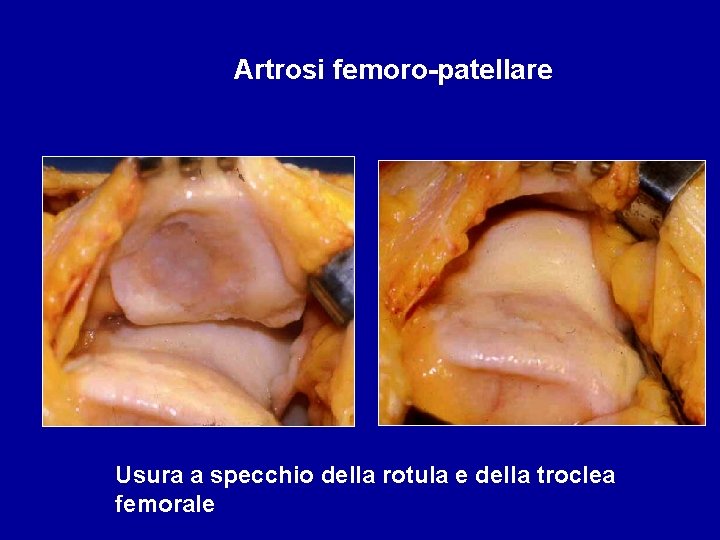 Artrosi femoro-patellare Usura a specchio della rotula e della troclea femorale 