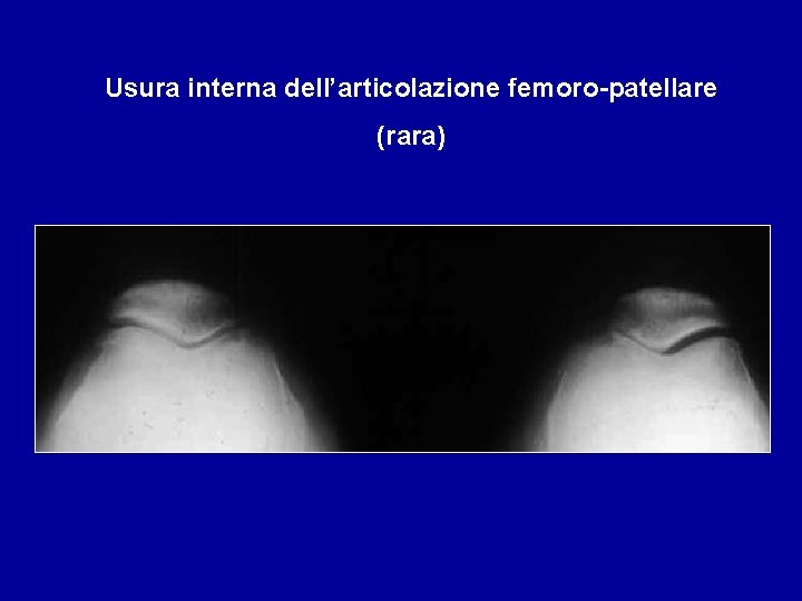 Usura interna dell’articolazione femoro-patellare (rara) 
