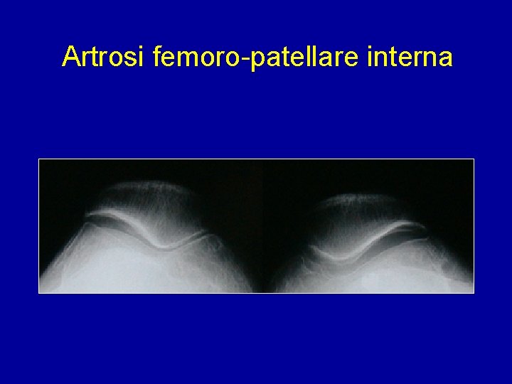 Artrosi femoro-patellare interna 