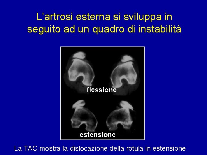 L’artrosi esterna si sviluppa in seguito ad un quadro di instabilità flessione estensione La