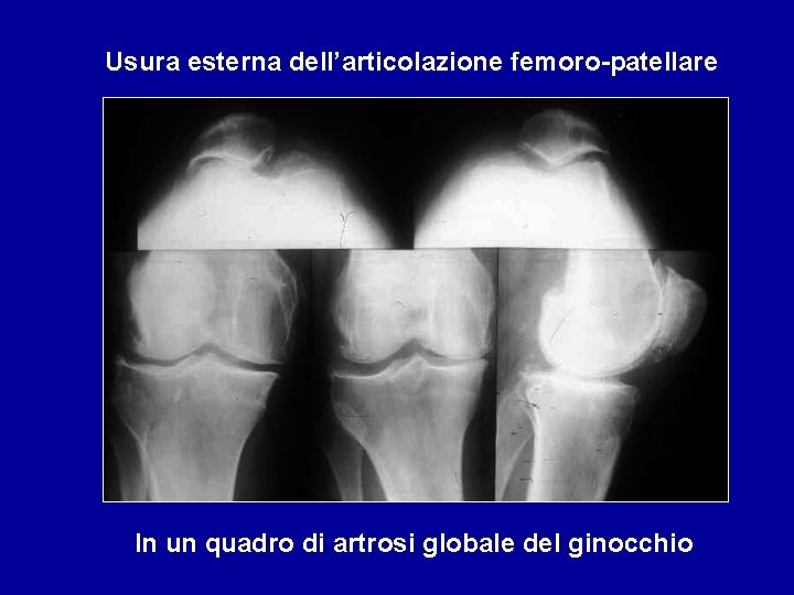 Usura esterna dell’articolazione femoro-patellare In un quadro di artrosi globale del ginocchio 