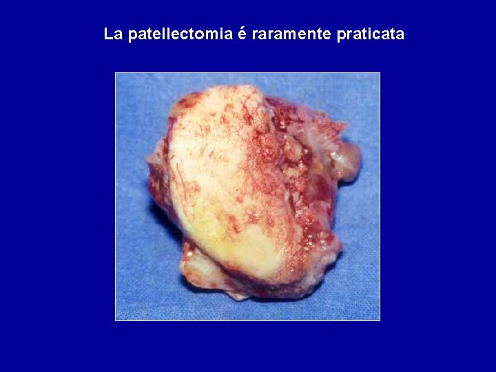 La patellectomia é raramente praticata 
