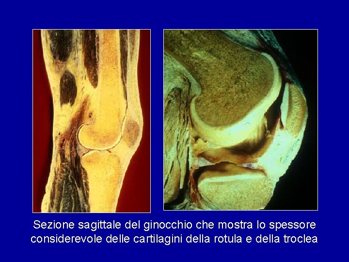 Sezione sagittale del ginocchio che mostra lo spessore considerevole delle cartilagini della rotula e