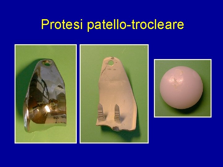 Protesi patello-trocleare 