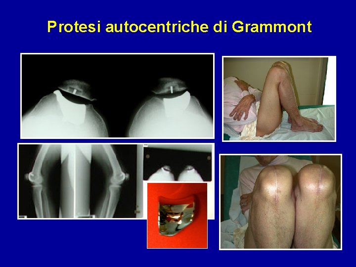 Protesi autocentriche di Grammont 
