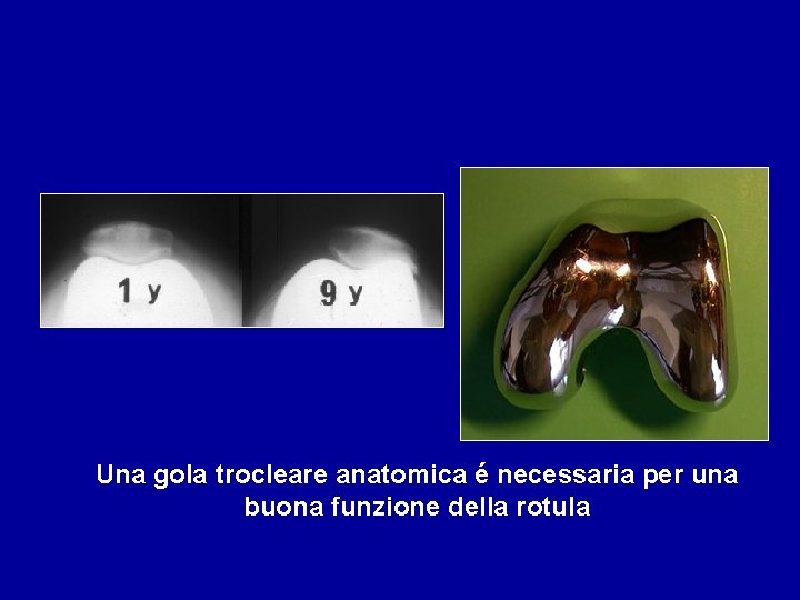 Una gola trocleare anatomica é necessaria per una buona funzione della rotula 