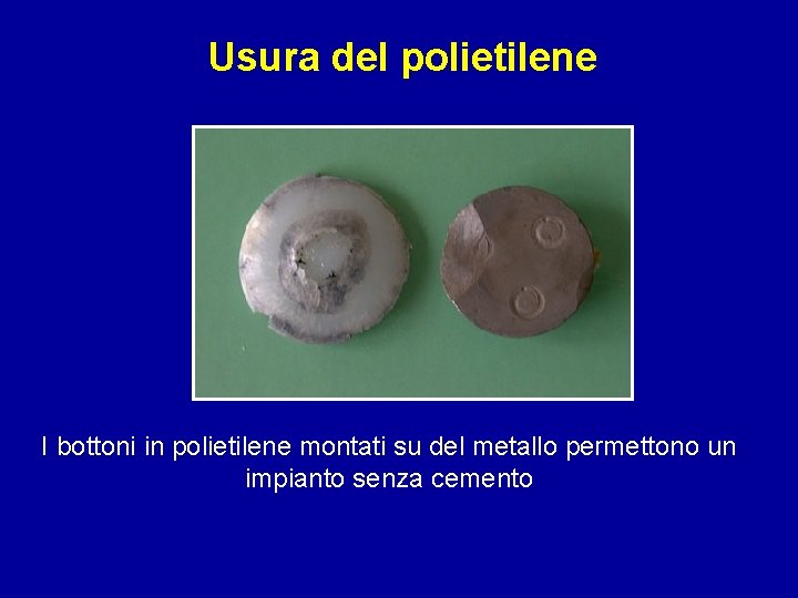 Usura del polietilene I bottoni in polietilene montati su del metallo permettono un impianto